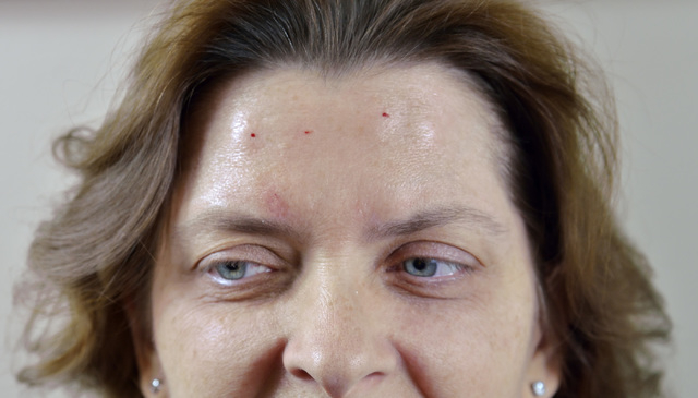 Patient Nancy Buckley is shown after being injected with Botox to help with treatment of her migraine headaches at the Nevada Neurosciences Institute at 3131 La Canada St. in Las Vegas on Thursday ...