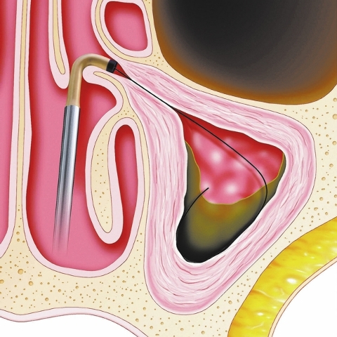 Balloon Sinuplasty (BSP) uses a small, flexible, balloon catheter to open up blocked sinus passageways and facilitate drainage of the mucus that builds up in patients suffering from chronic sinusi ...