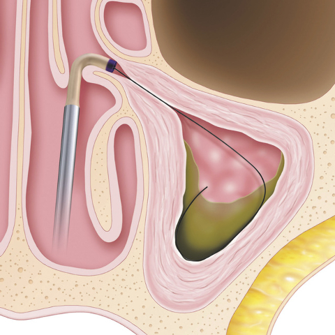 Balloon Sinuplasty (BSP) uses a small, flexible, balloon catheter to open up blocked sinus passageways and facilitate drainage of the mucus that builds up in patients suffering from chronic sinusi ...