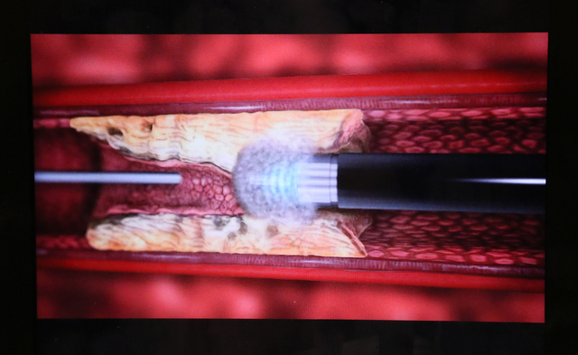 A still shot of a video demonstrating a low-risk laser atherectomy procedure to treat patients with vascular disease is shown at the office of Dr. Kenneth Shah at Vascular Institute of Southern Ne ...