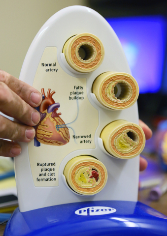 Dr. Kenneth Shah holds a model that shows a healthy artery in comparison to various arteries displaying problems relating to vascular disease at Vascular Institute of Southern Nevada Tuesday, May ...