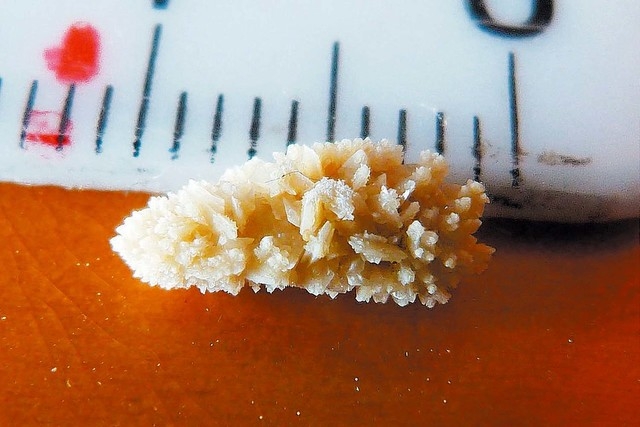 Does Energy Drinks Cause Kidney Stones?
