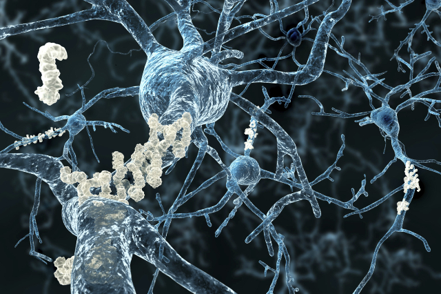 Alzheimer‘s disease - neurons with amyloid plaques (Thinkstock)