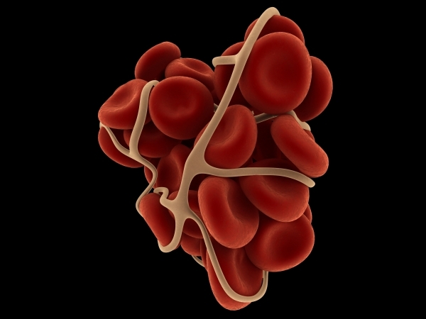 blood clot