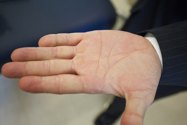 Dr. Randall James from the North Las Vegas VA Medical Center holds up an Acupuncture Semi-Permanent needle (ASP) on Friday, June 6, 2016. He uses these types of acupuncture needles on his patient ...