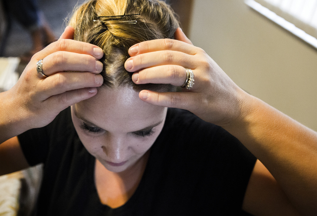 Jolie Furrow, 32, shows one of six cysts on her head on Thursday, Aug. 11, 2016 in Las Vegas. The family claims her health issues are caused by tainted water her parents consumed while her father ...