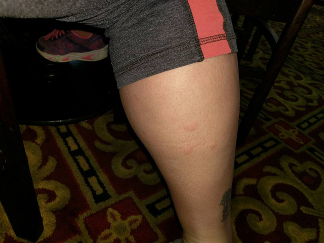Barbi Stenstrom's leg is shown in a photo posted to her Facebook page Sunday, Sept. 11, 2016. Stenstrom said the welts are a result of bed bugs in a booth at Hometown Kitchen restaurant inside the ...