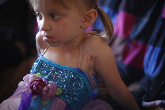 The rashes caused by Goltz syndrome can be seen on Ella's face and arms as she watches T.V. at her home on Friday, Nov. 4, 2016, in Tonopah, Nevada. Rachel Aston/Las Vegas Review-Journal Follow @r ...