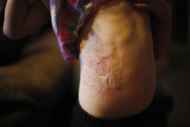 Ella Hathaway, 4, shows scars from her birth on Tuesday, Oct. 4, 2016, at her home in Tonopah, Nev. She has a rare disease called Goltz Syndrome. Rachel Aston/Las Vegas Review-Journal Follow @rook ...