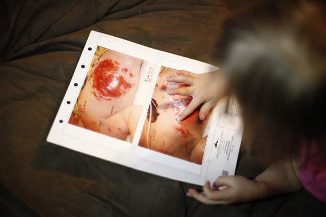 Ella Hathaway, 4, shows the photos of her infant self on Tuesday, Oct. 4, 2016, at her home in Tonopah, Nev. She has a rare disease called Goltz Syndrome. Rachel Aston/Las Vegas Review-Journal Fol ...
