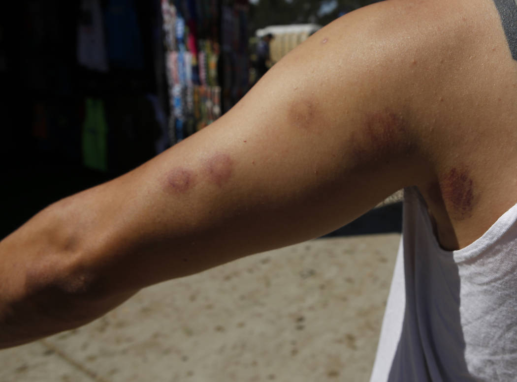 Target Lesions And Other Paintball Injuries American Board, 54 OFF