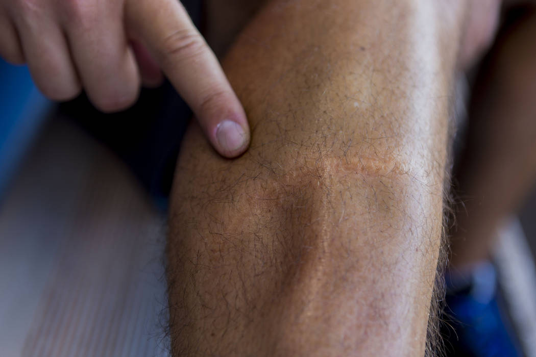 Las Vegas 51s pitcher Beck Wheeler shows his scar from a boating accident in 2007, at Cashman Field in Las Vegas, Wednesday, July 5, 2017. Elizabeth Brumley Las Vegas Review-Journal