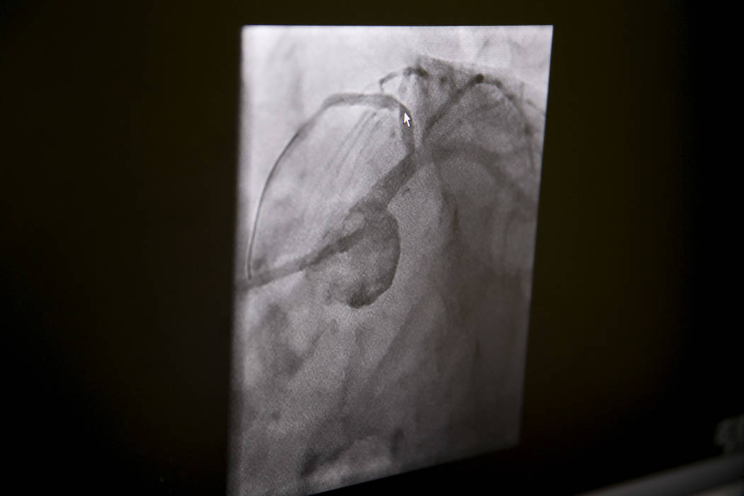 An X-ray of a "widow-maker" blockage before a heart catheterization procedure at the Catheterization Laboratory "Cath Lab" of Spring Valley Hospital Medical Center in Las Vegas, Tuesday, July 11,  ...