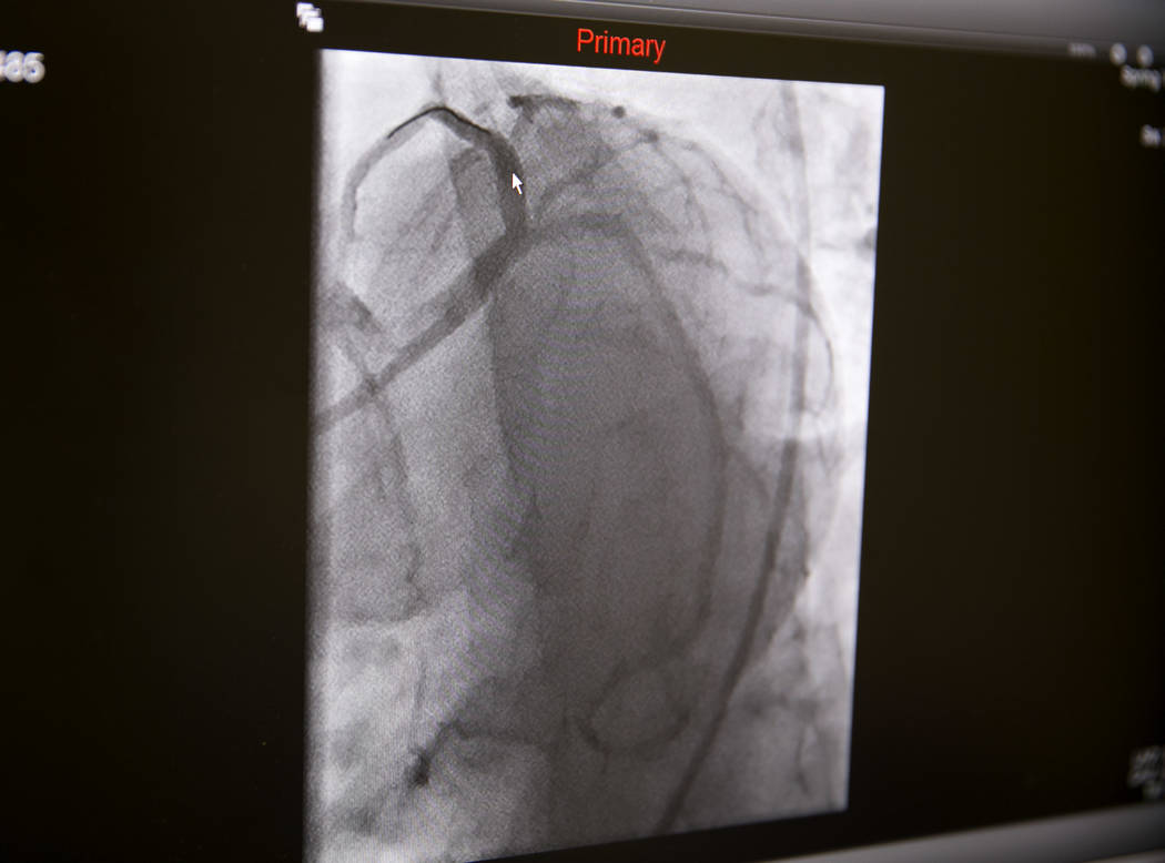 An X-ray of a heart after a widow-maker blockage is removed at the Catheterization Laboratory "Cath Lab" of Spring Valley Hospital Medical Center in Las Vegas, Tuesday, July 11, 2017. (Gabriella A ...