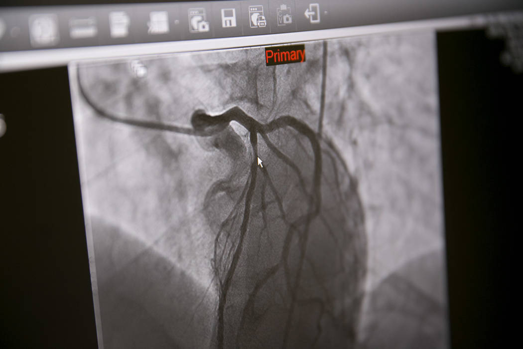 An X-ray of a "widow-maker"  blockage before a wire from a heart catheterization procedure is inserted into the heart chamber at the Catheterization Laboratory "Cath Lab" of Spring Valley Hospital ...