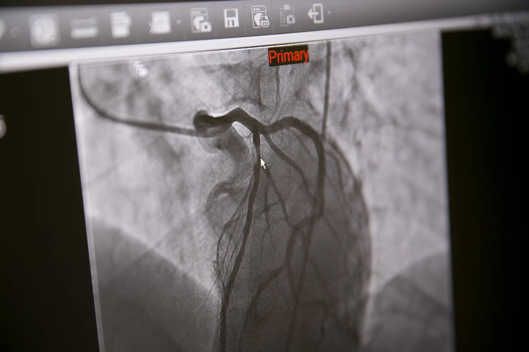 An X-ray of a "widow-maker" blockage before a wire from a heart catheterization procedure is inserted into the heart chamber at the Catheterization Laboratory "Cath Lab" of Spring Valley Hospital ...