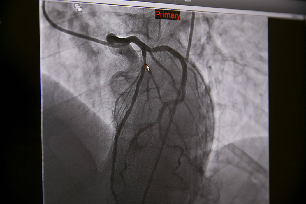 An X-ray of a "widow-maker" blockage before a wire from a heart catheterization procedure is inserted into the heart chamber at the Catheterization Laboratory "Cath Lab" of Spring Valley Hospital ...