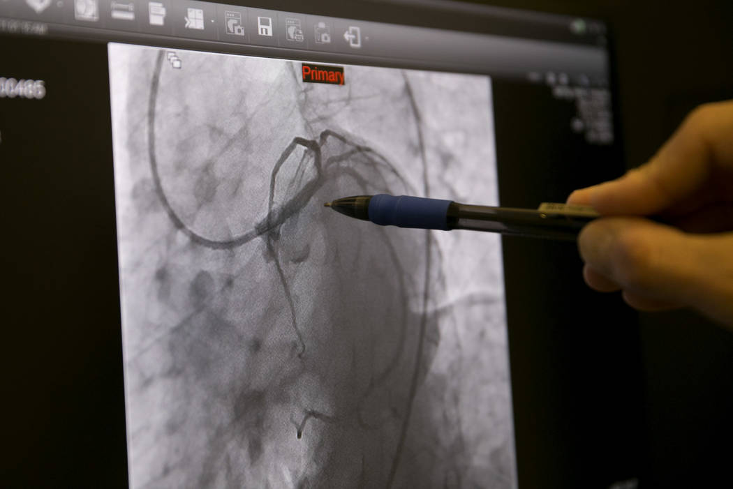 An X-ray of a fixed "widow-maker" blockage during a heart catheterization procedure. The pen is pointing to where the blockage was, and the thin black line is a wire. (Gabriella Angotti-Jones/Las  ...