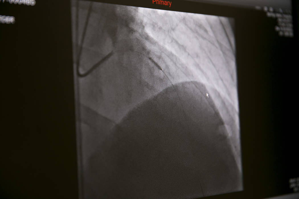 An X-ray of a heart catheterization balloon in a patient's heart at the Catheterization Laboratory "Cath Lab" of Spring Valley Hospital Medical Center in  Las Vegas, Tuesday, July 11, 2017. (Gabri ...