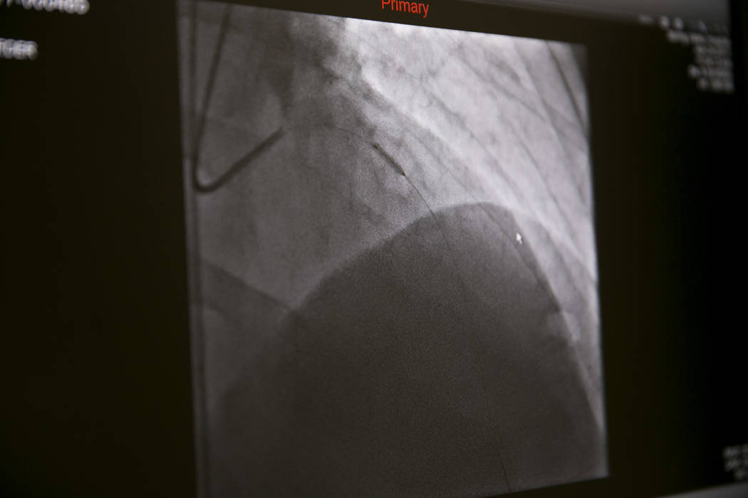 An X-ray of a heart catheterization balloon in a patient's heart at the Catheterization Laboratory "Cath Lab" of Spring Valley Hospital Medical Center in Las Vegas, Tuesday, July 11, 2017. (Gabri ...