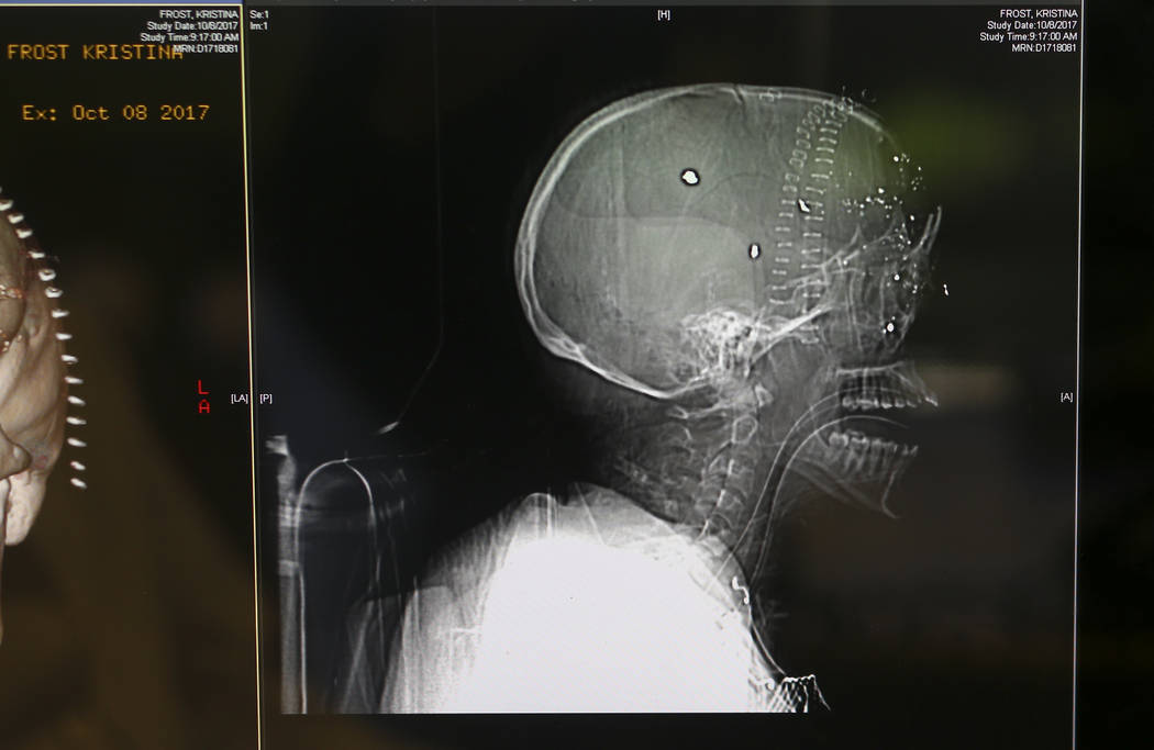 Dr. Keith Blum, a neurosurgeon who was on call at Sunrise Hospital and Medical Center the night of the mass shooting, looks at brain scans of patient Tina Frost at his office in Las Vegas on Wedne ...