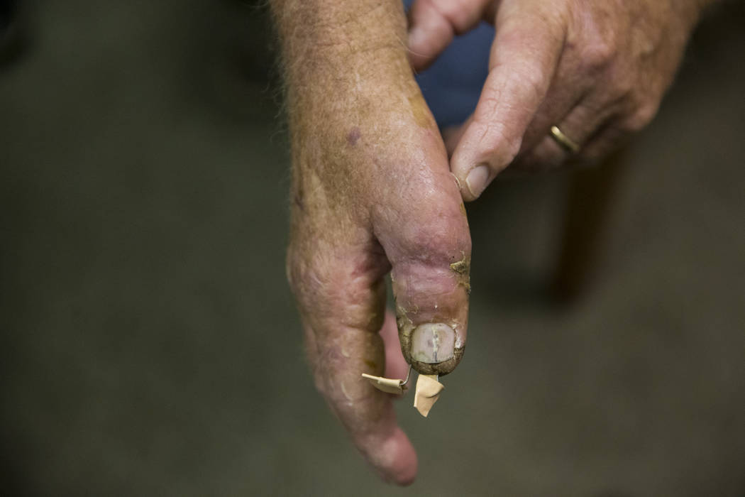 When Can a Severed Finger Be Reattached?