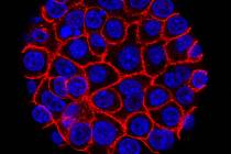 This undated microscope image from USC via the NIH shows pancreatic cancer cells, nuclei in blu ...