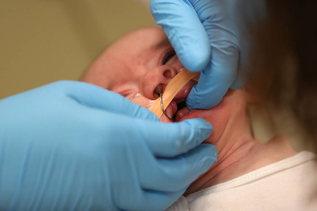 Dr. Glen Roberson, an orthodontist at the Orthodontic Clinic at Roseman University, during a procedure to adjust the nasoalveolar molding (NAM) of Blake Muschong, a 10-week-old baby with a cleft p ...