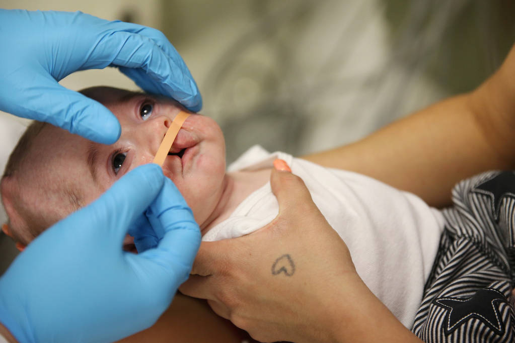 Dr. Glen Roberson, an orthodontist at the Orthodontic Clinic at Roseman University, during a procedure to adjust the nasoalveolar molding (NAM) of Blake Muschong, a 10-week-old baby with a cleft p ...