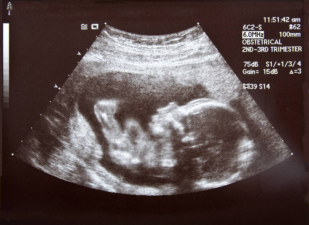 An ultrasound of a human fetus during the 17th week. (Adobe)