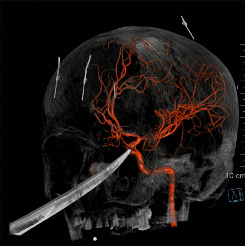This 3D computer graphic model made from X-Ray imagery by The University of Kansas Health Syste ...