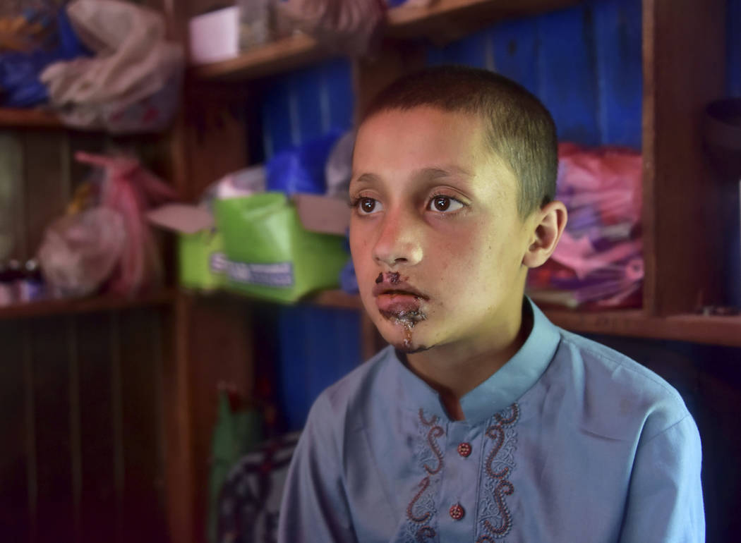 A Pakistani Kashmiri boy Mazhar Hussain, shows his injuries he received when Indian forces fire ...