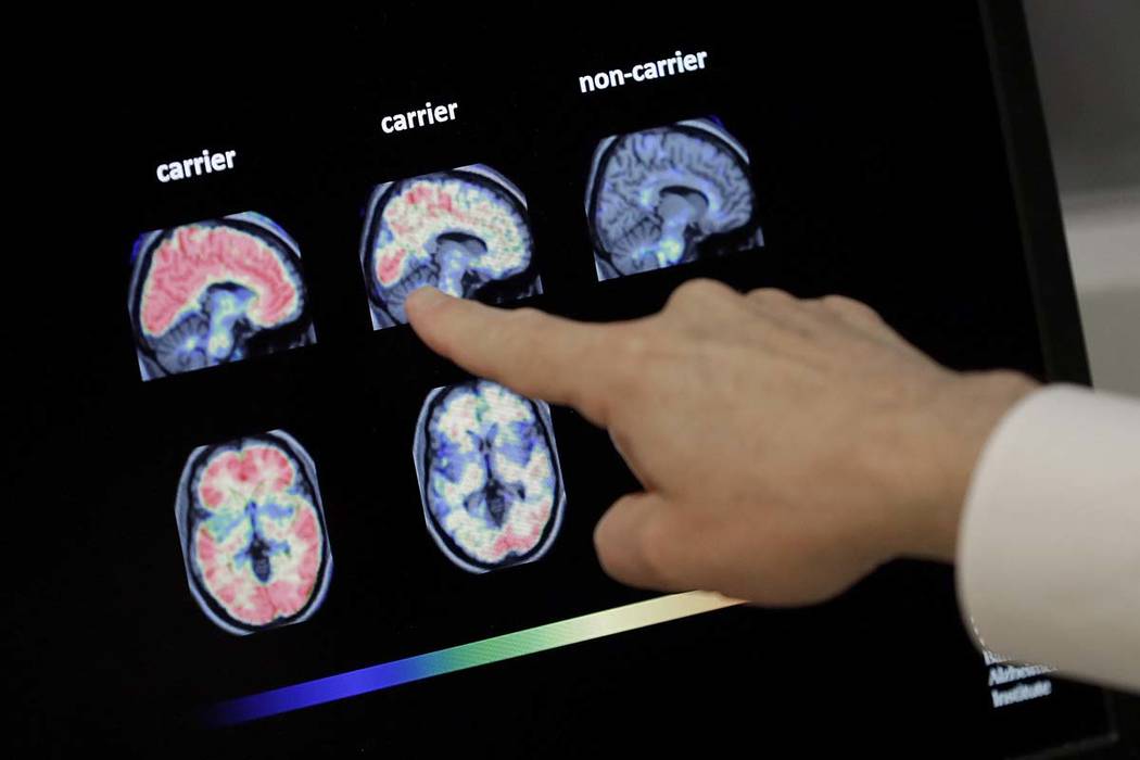 Dr. William Burke goes over a PET brain scan at Banner Alzheimers Institute in Phoenix, Aug. 14 ...