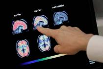 Dr. William Burke goes over a PET brain scan at Banner Alzheimers Institute in Phoenix, Aug. 14 ...