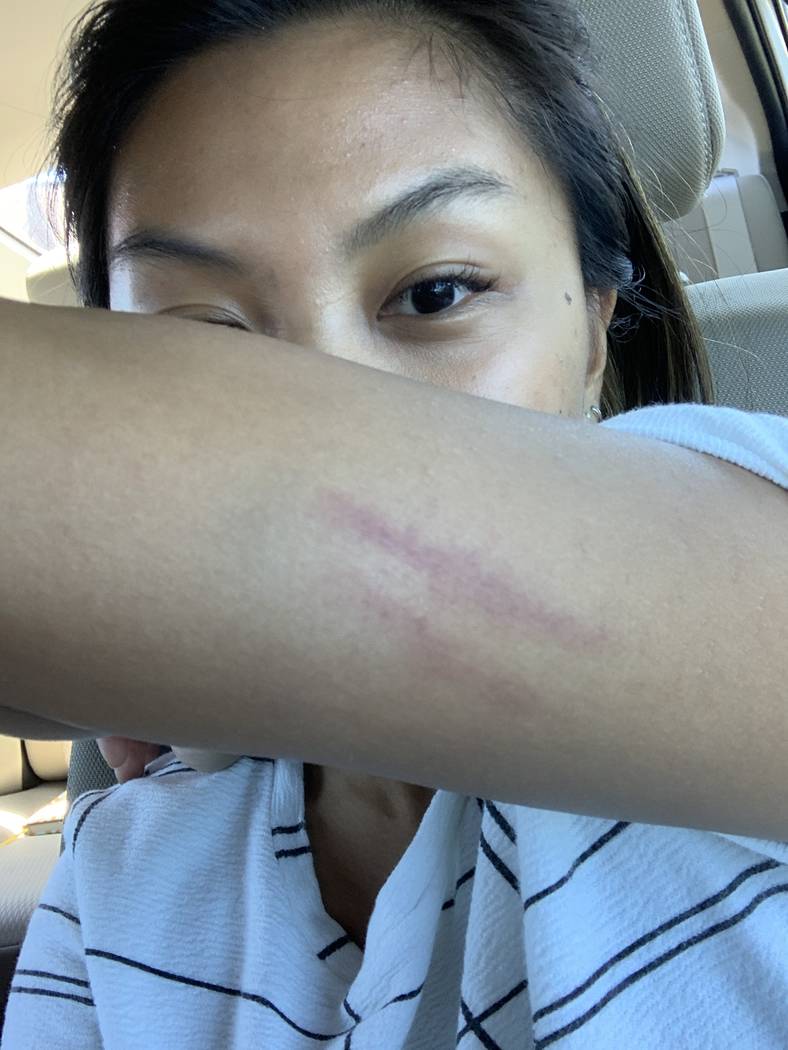 A bruise shaped like a dog bite forms immediately after Review-Journal reporter Rio Lacanlale, ...