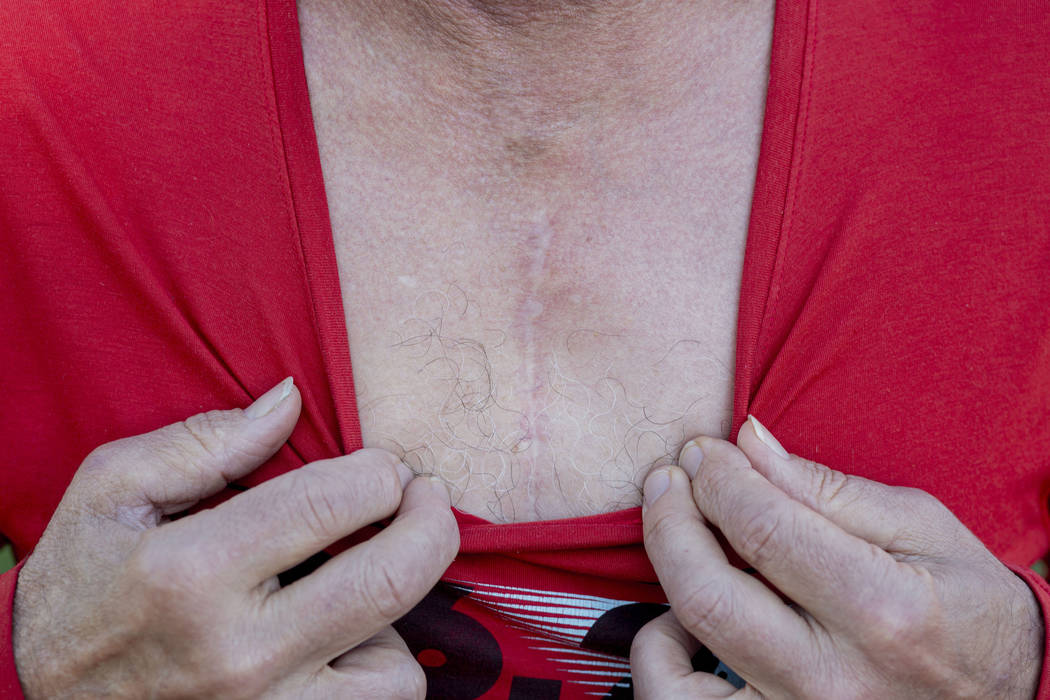 Las Vegan marathon runner Randy Lazer shows his scars on his chest from his multiple heart surg ...