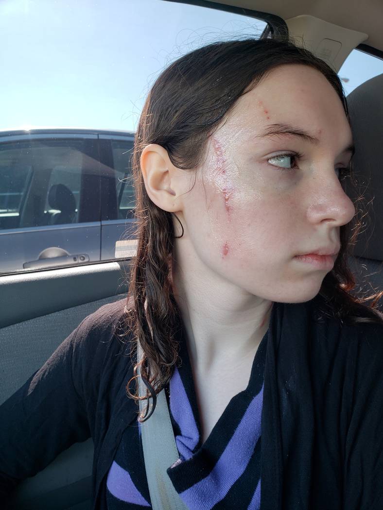 Sixteen-year-old Alyssa Canning was attacked by another patient during her stay at Montevista H ...