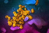Novel Coronavirus SARS-CoV-2, yellow, emerging from the surface of cells, blue/pink, cultured i ...