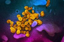 Novel Coronavirus SARS-CoV-2, yellow, emerging from the surface of cells, blue/pink, cultured i ...