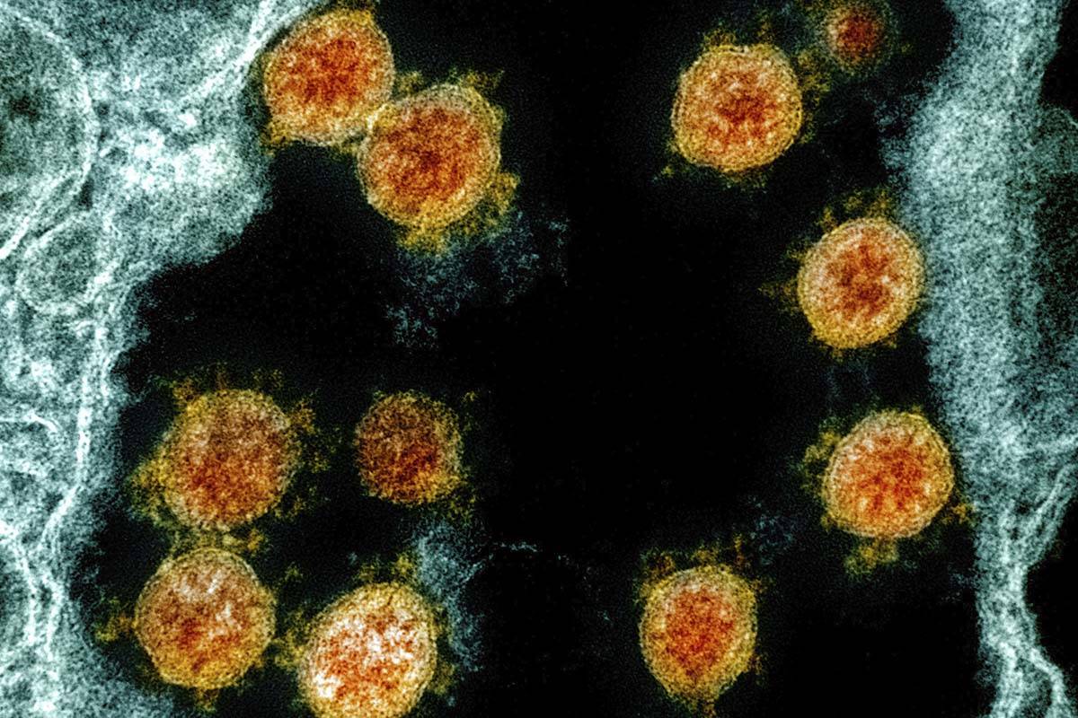 An electron microscope image shows Novel Coronavirus SARS-CoV-2 virus particles, orange, isolat ...