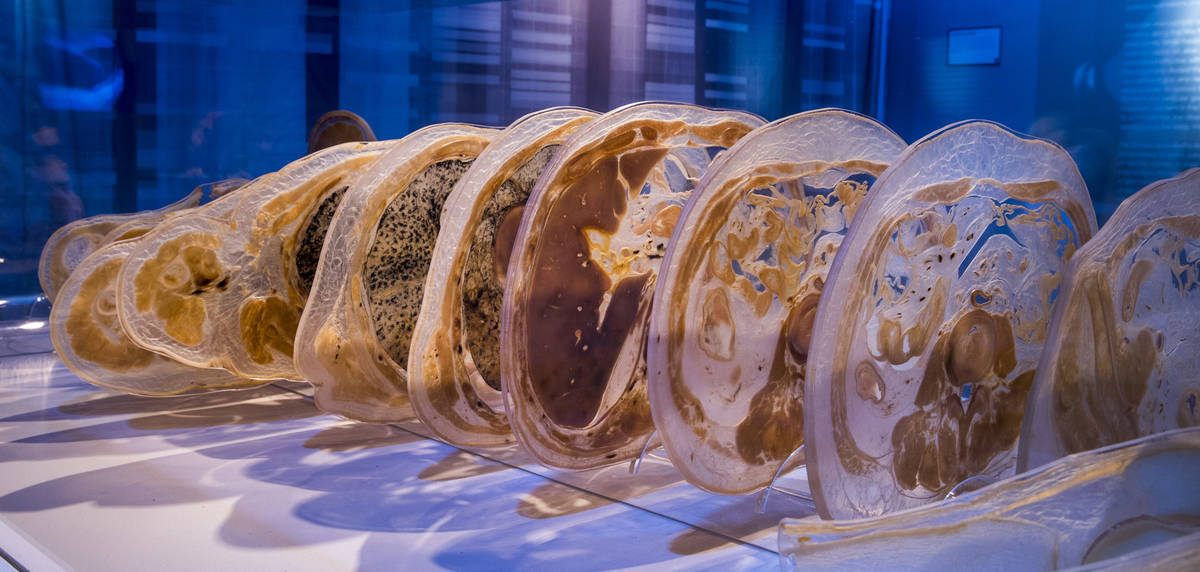 ‘Real Bodies’ exhibit at Bally’s adds COVID content Las Vegas Review