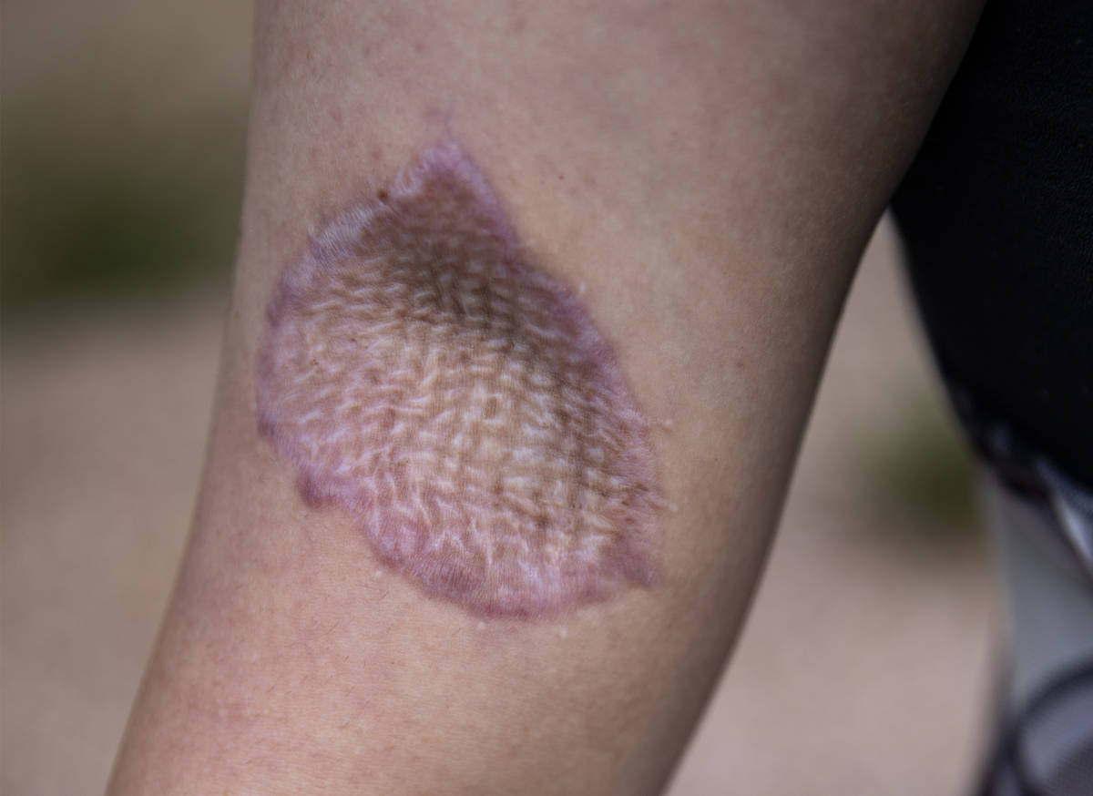 Ashleigh Cope, who contracted a flesh-eating bacteria infection in 2019 after a cosmetic plasti ...