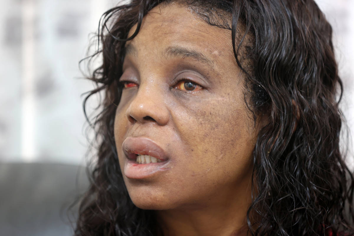 Latoshia Johnson, who struggles to open her eyes after a severe beating, talks to a reporter at ...