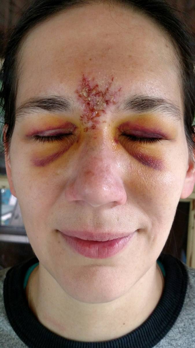 Boston Red Sox fan Stephanie Wapenski was hit on her forehead by a foul ball in a 2015 game at ...