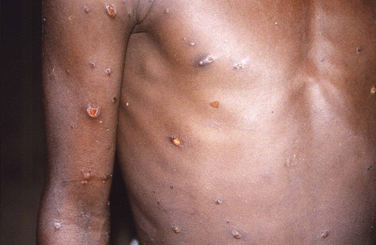 This 1997 image provided by CDC, shows the right arm and torso of a patient, whose skin display ...