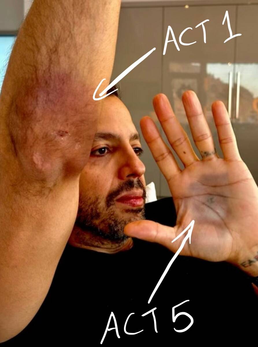David Blaine shows two of his injuries he has incurred during his "In Spades" show at Resorts W ...