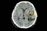 Rare brain infection not communicable, but spike in local kids remains a mystery