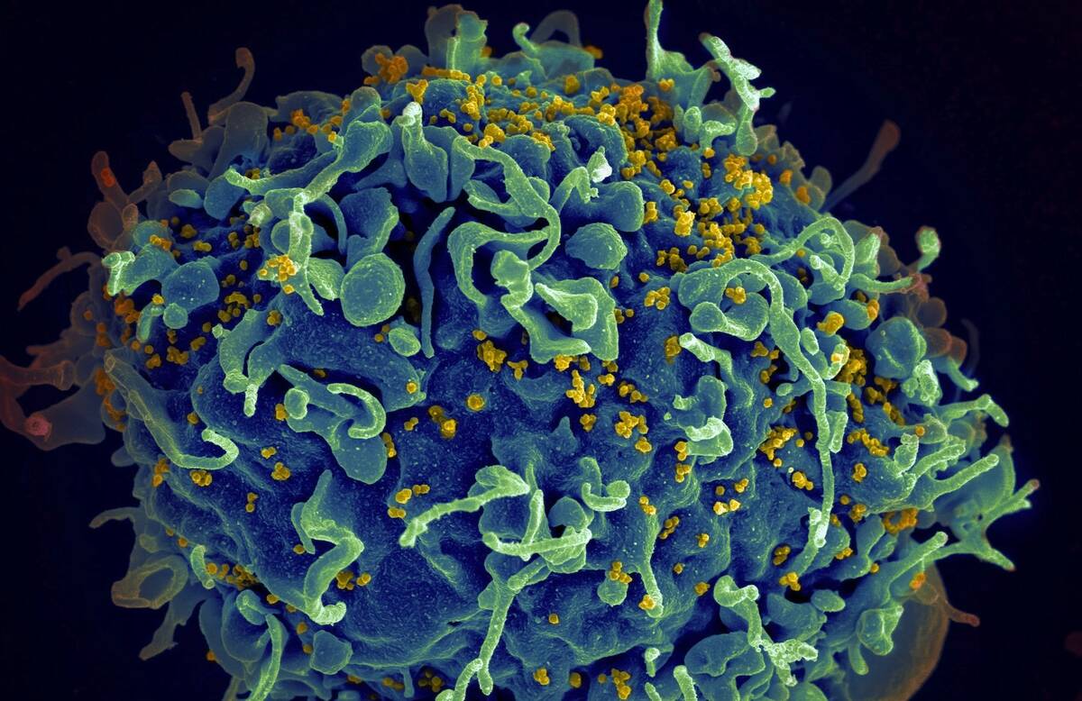 HIV virus (yellow) infecting a human cell (National Cancer Institute)