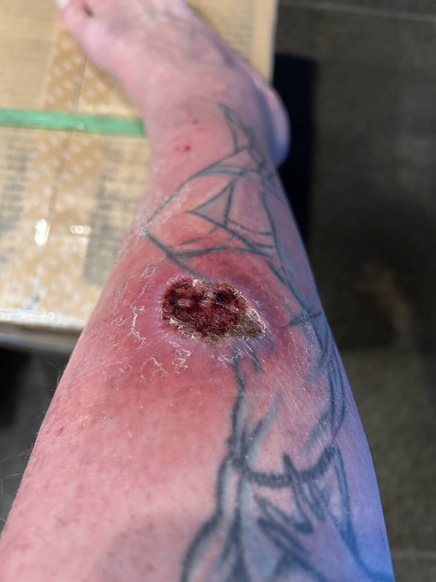 A shot of Corey Harrison's infected right leg, which he contends hindered his ability to pass a ...
