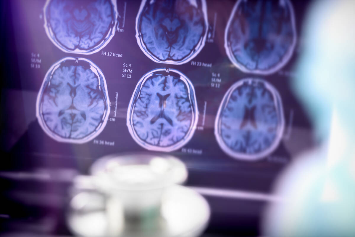Alzheimer's disease and vascular dementia: Possible new cause uncovered - Vimarsana News
